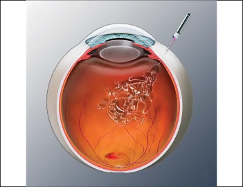 intravitreal injections